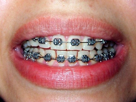 Orthodontic Appliance